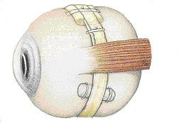 Bild: Augapfel mit Cerclage